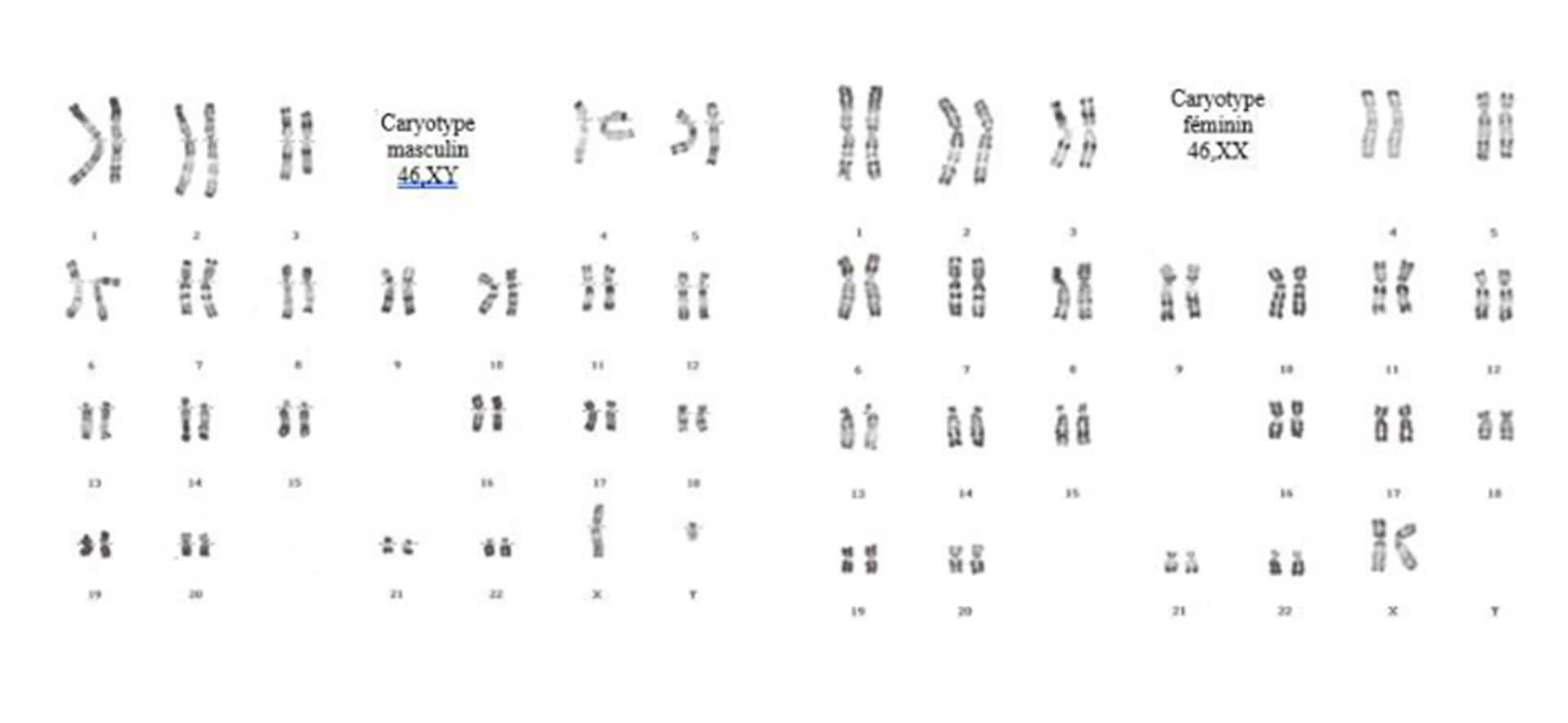 Trisomie 21 Nouvelle Aquitaine