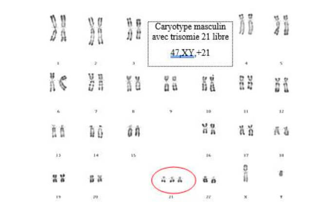 Trisomie 21 Nouvelle Aquitaine